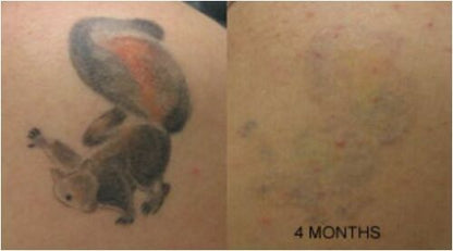 Tattoo Destroyer - Tattoo Removal Cream - Prime Devine Supply16233804136494Tattoo removal cream1 Month