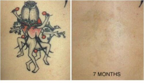 Tattoo Destroyer - Tattoo Removal Cream - Prime Devine Supply16233804136494Tattoo removal cream1 Month