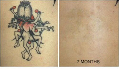 Tattoo Destroyer - Tattoo Removal Cream - Prime Devine Supply16233804136494Tattoo removal cream1 Month